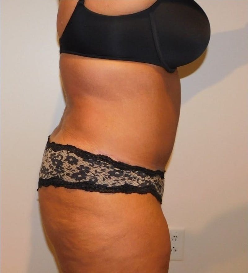 Mommy Makeover Before & After Gallery - Patient 288407 - Image 10