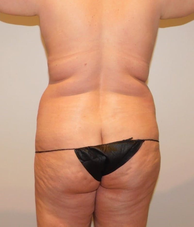 Mommy Makeover Before & After Gallery - Patient 288407 - Image 11
