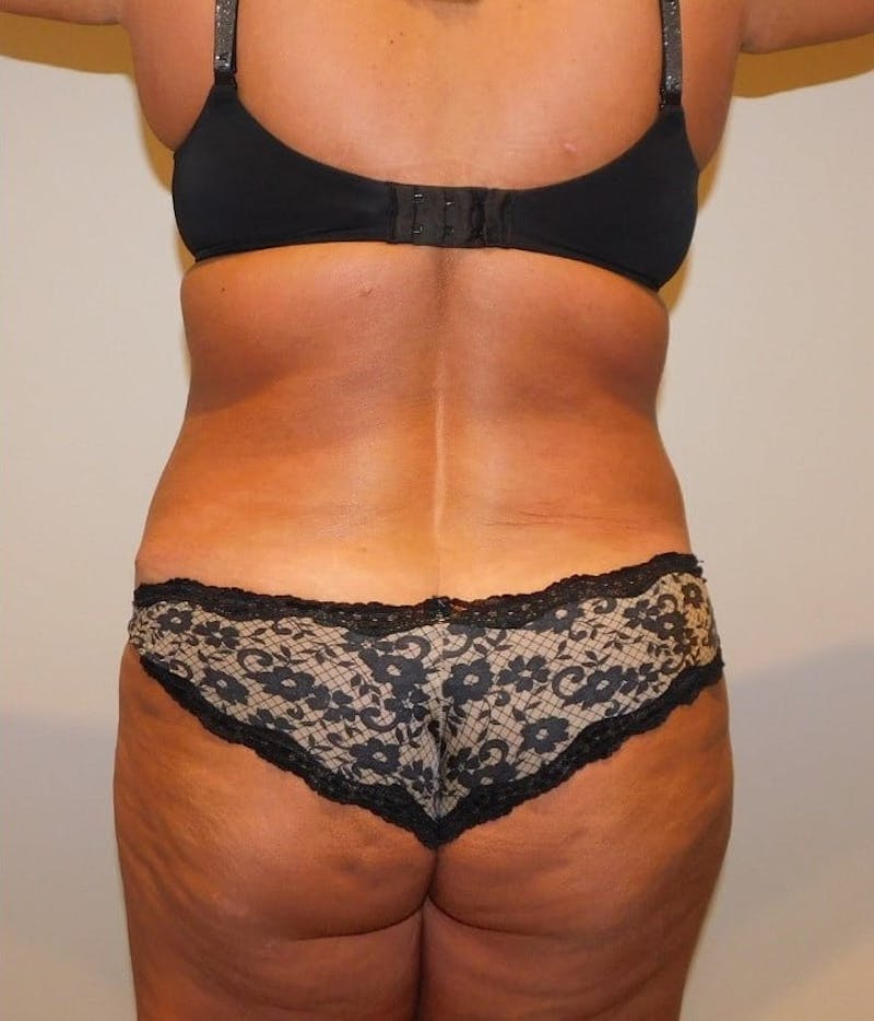 Mommy Makeover Before & After Gallery - Patient 288407 - Image 12
