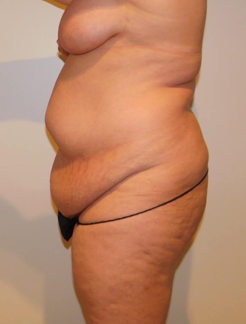 Mommy Makeover Before & After Gallery - Patient 288407 - Image 13