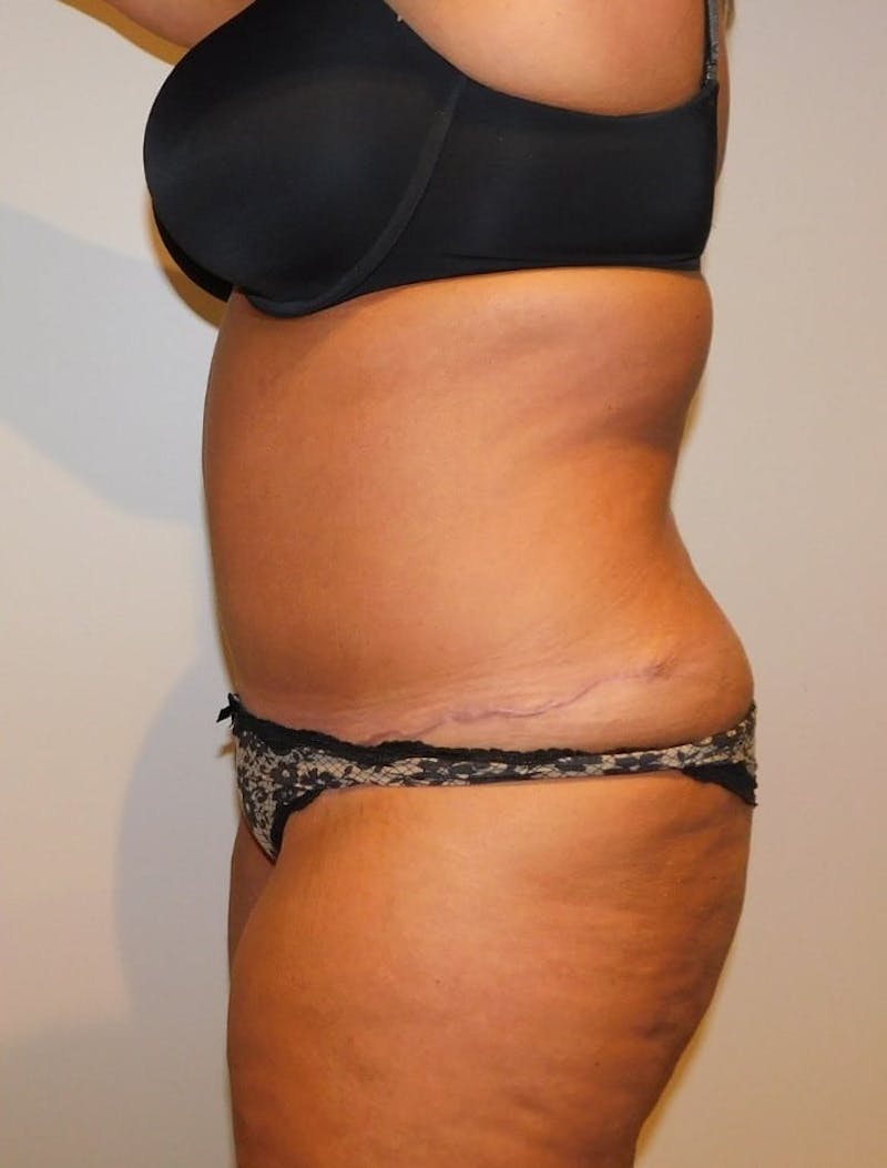 Mommy Makeover Before & After Gallery - Patient 288407 - Image 14