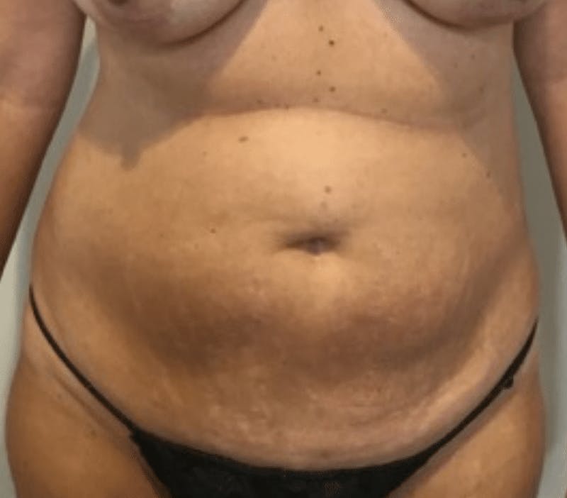 Tummy Tuck Before & After Gallery - Patient 287330 - Image 1