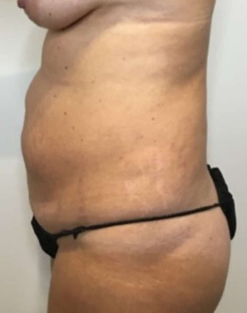Tummy Tuck Before & After Gallery - Patient 287330 - Image 3