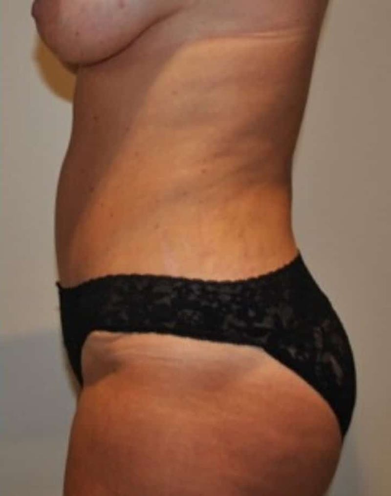 Tummy Tuck Before & After Gallery - Patient 287330 - Image 4