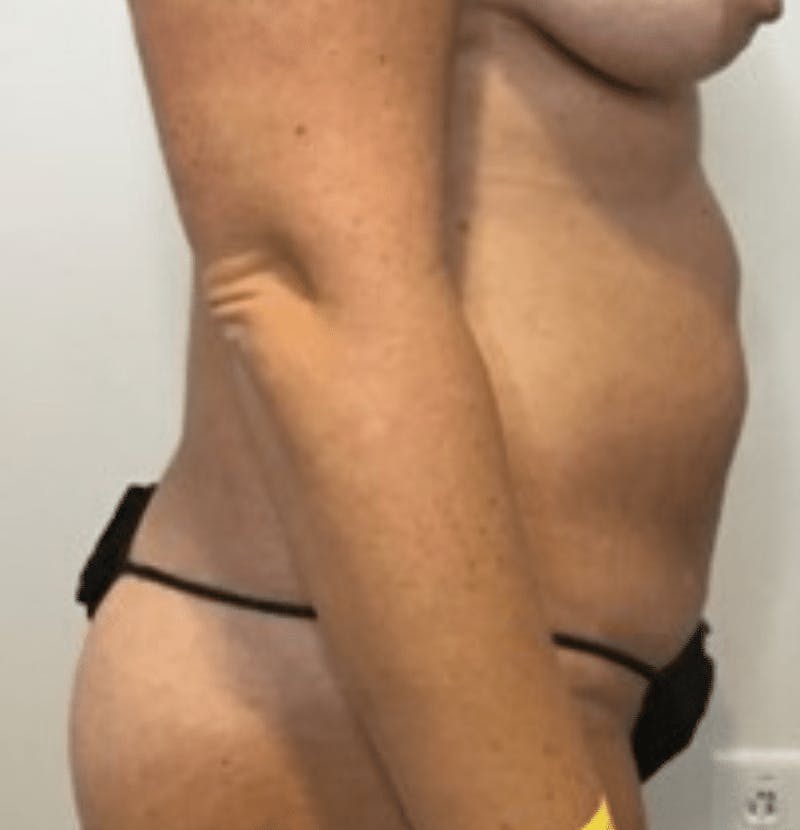 Tummy Tuck Before & After Gallery - Patient 287330 - Image 5