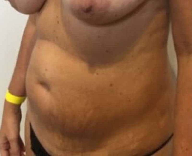 Tummy Tuck Before & After Gallery - Patient 287330 - Image 7