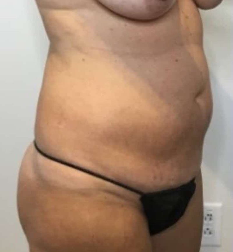 Tummy Tuck Before & After Gallery - Patient 287330 - Image 9