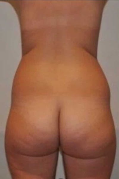 Brazilian Buttock Lift Before & After Gallery - Patient 296884 - Image 1