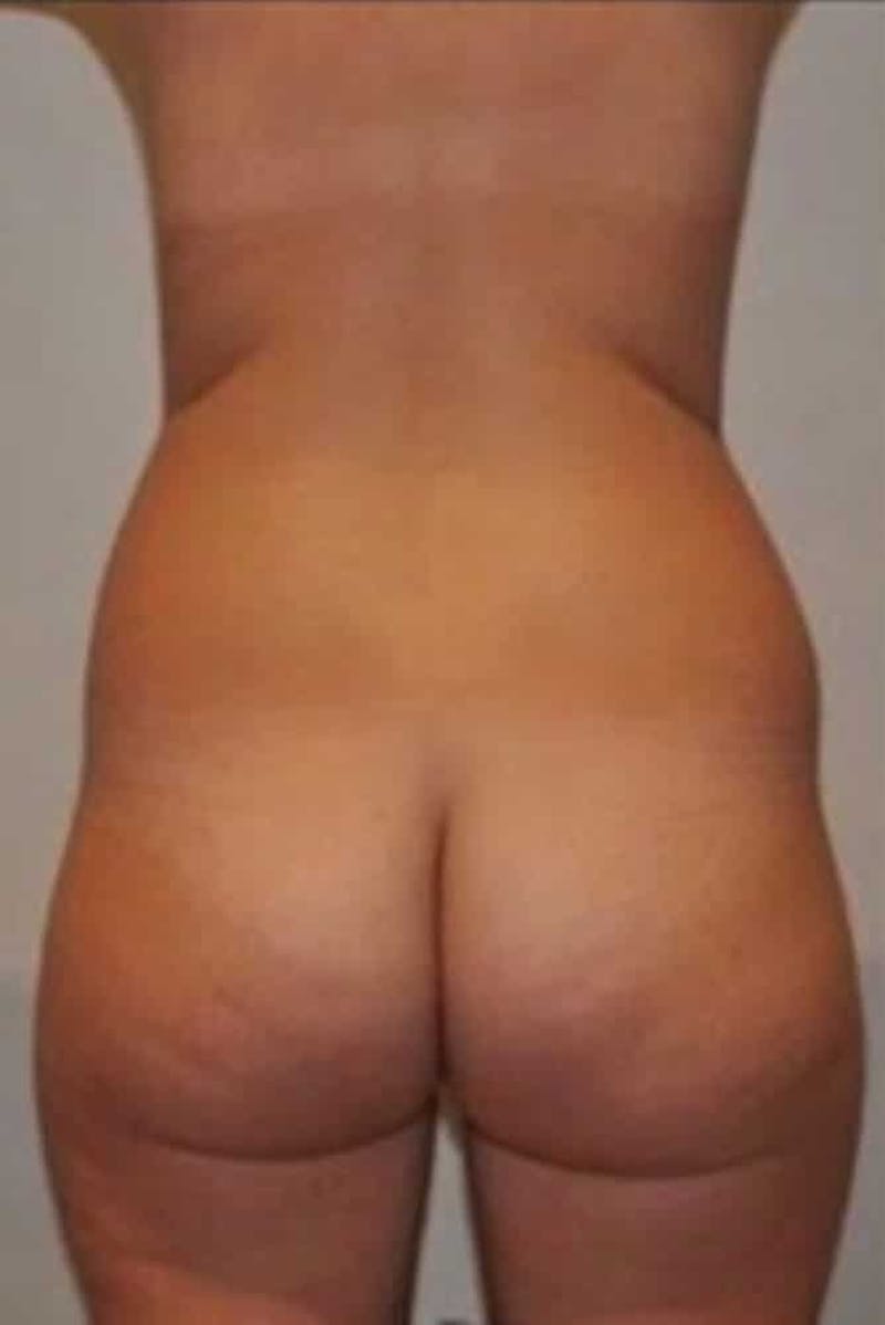 Brazilian Buttock Lift Before & After Gallery - Patient 296884 - Image 1