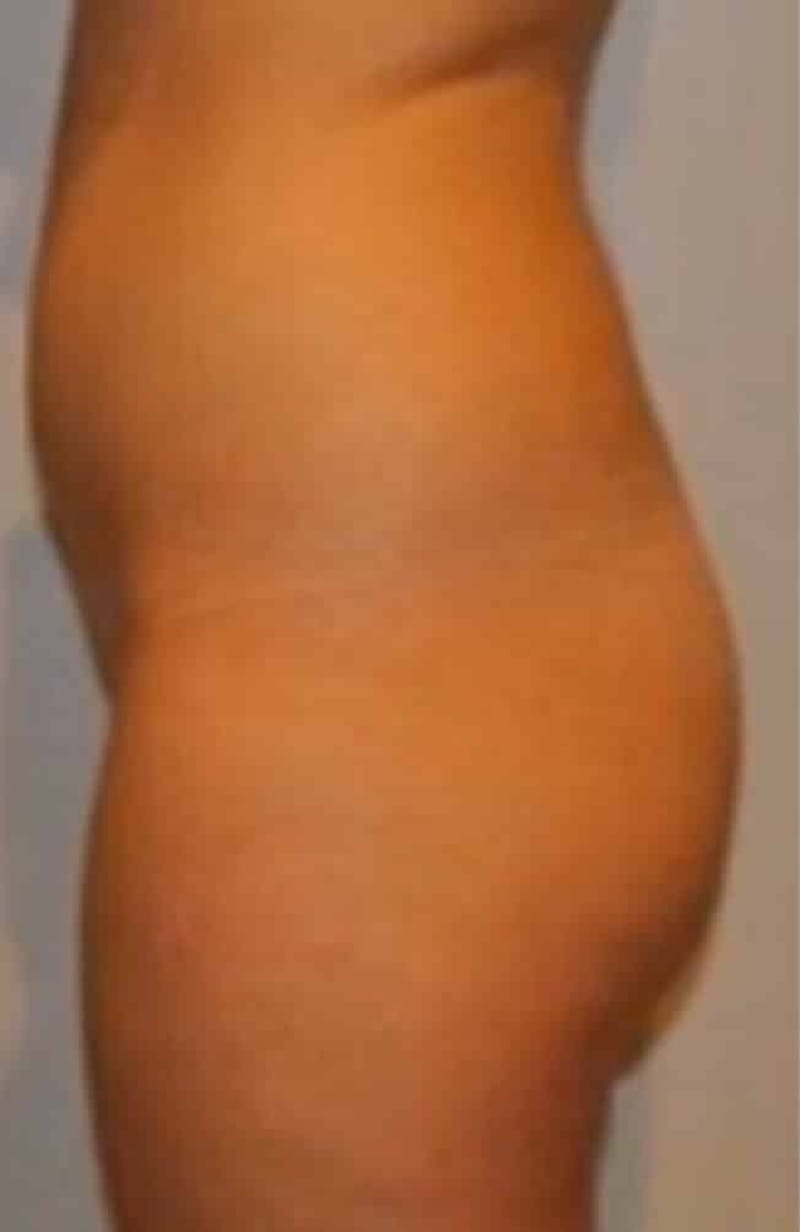 Brazilian Buttock Lift Before & After Gallery - Patient 296884 - Image 3