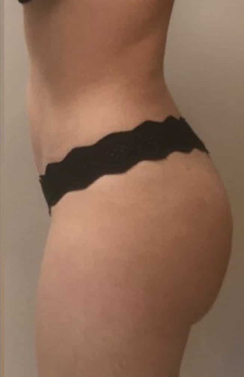 Brazilian Buttock Lift Before & After Gallery - Patient 296884 - Image 4