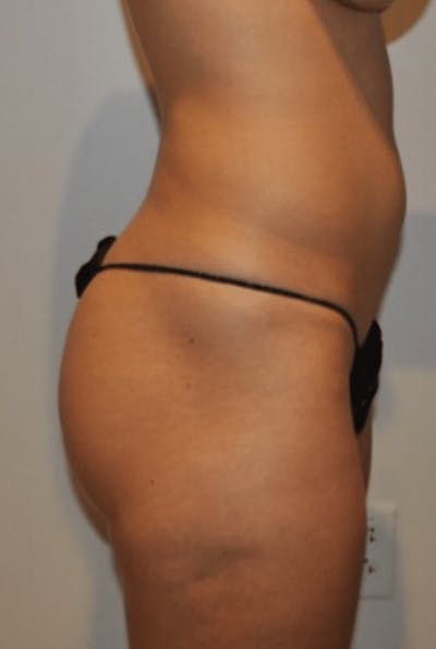 Brazilian Buttock Lift Before & After Gallery - Patient 356649 - Image 1