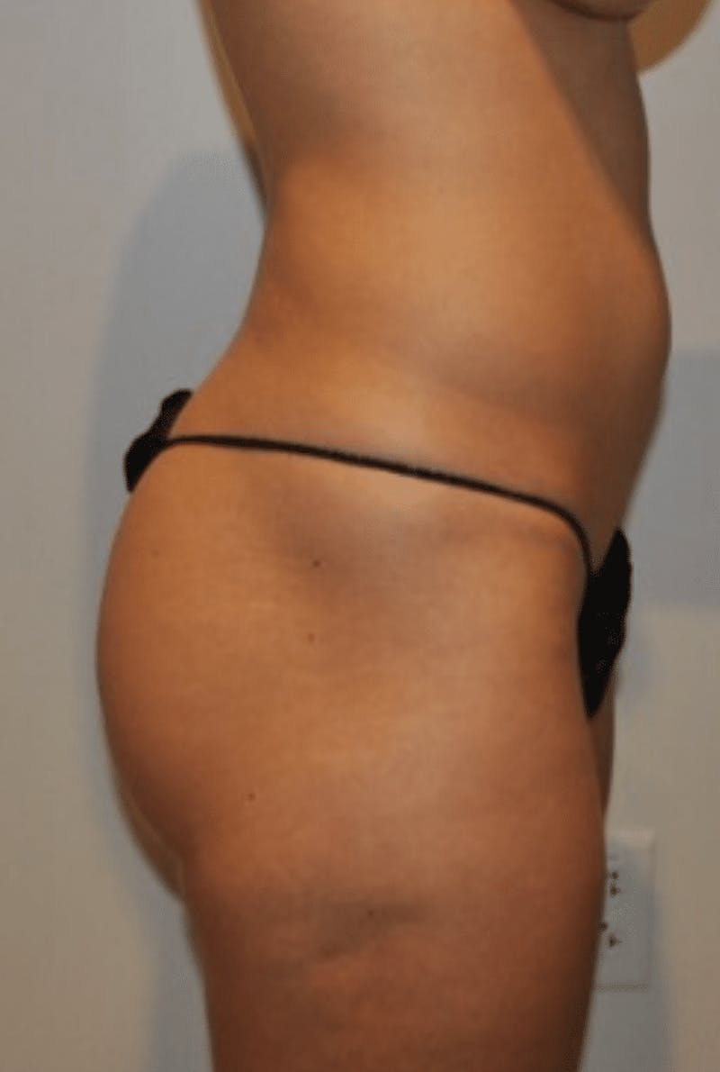 Brazilian Buttock Lift Before & After Gallery - Patient 356649 - Image 1