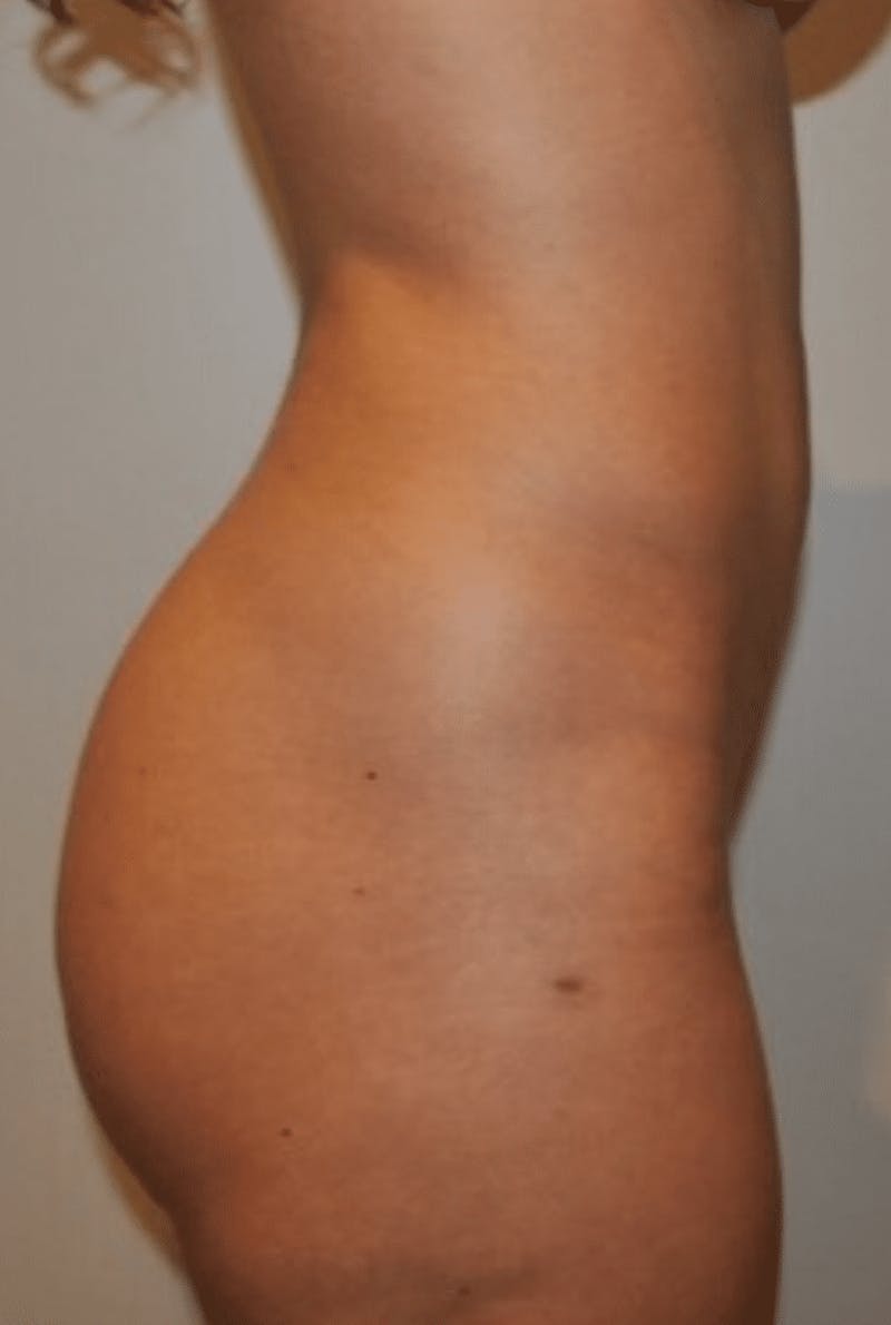 Brazilian Buttock Lift Before & After Gallery - Patient 356649 - Image 2