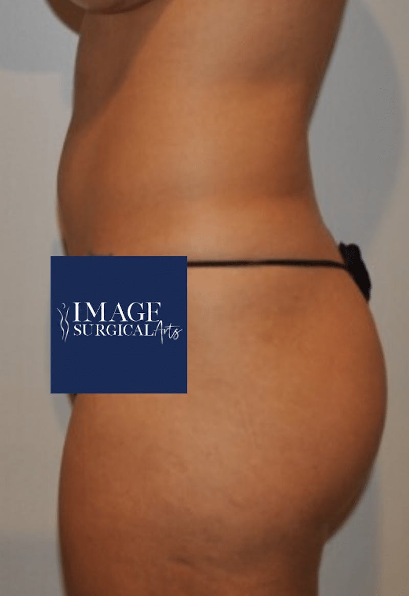 Brazilian Buttock Lift Before & After Gallery - Patient 356649 - Image 3