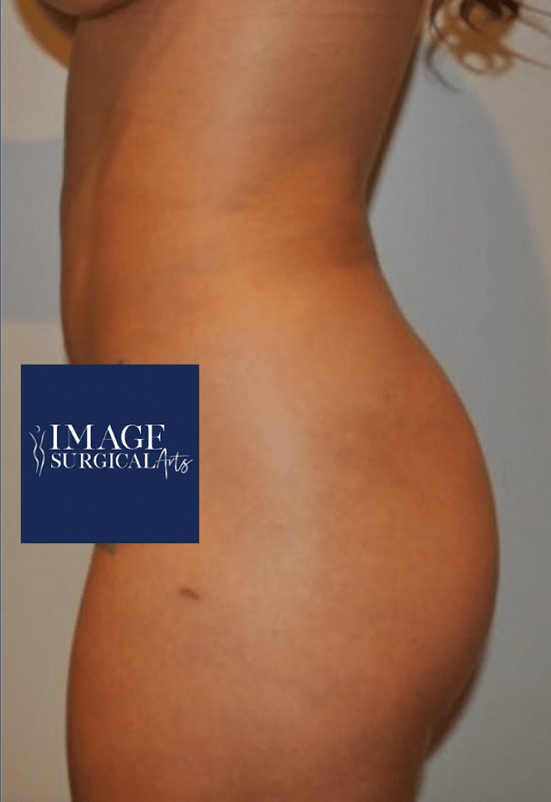 Brazilian Buttock Lift Before & After Gallery - Patient 356649 - Image 4