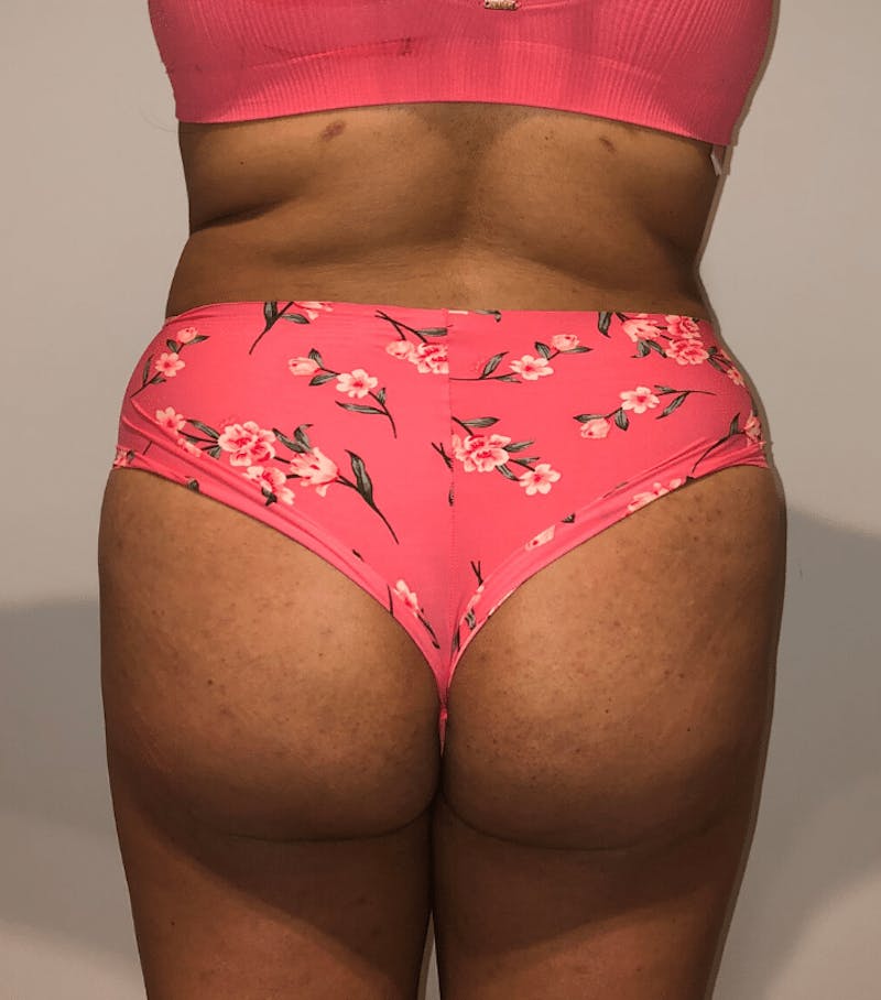 Brazilian Buttock Lift Before & After Gallery - Patient 200123 - Image 2