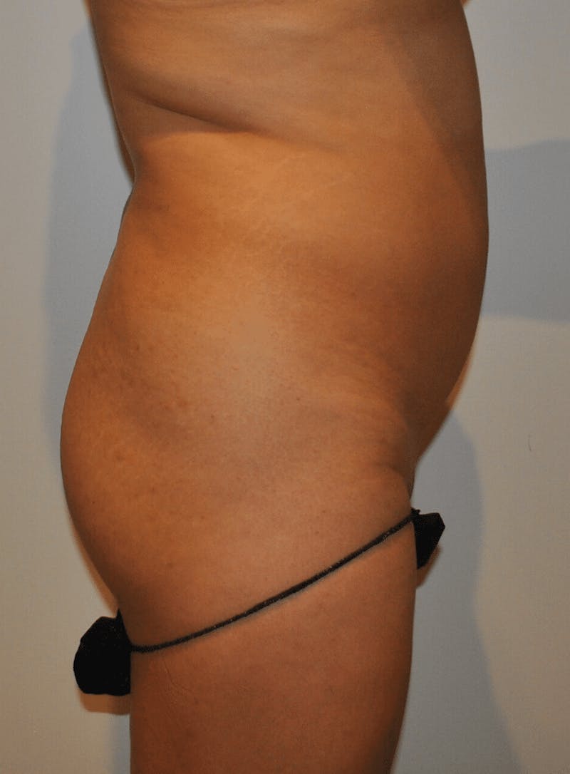 Brazilian Buttock Lift Before & After Gallery - Patient 200123 - Image 3