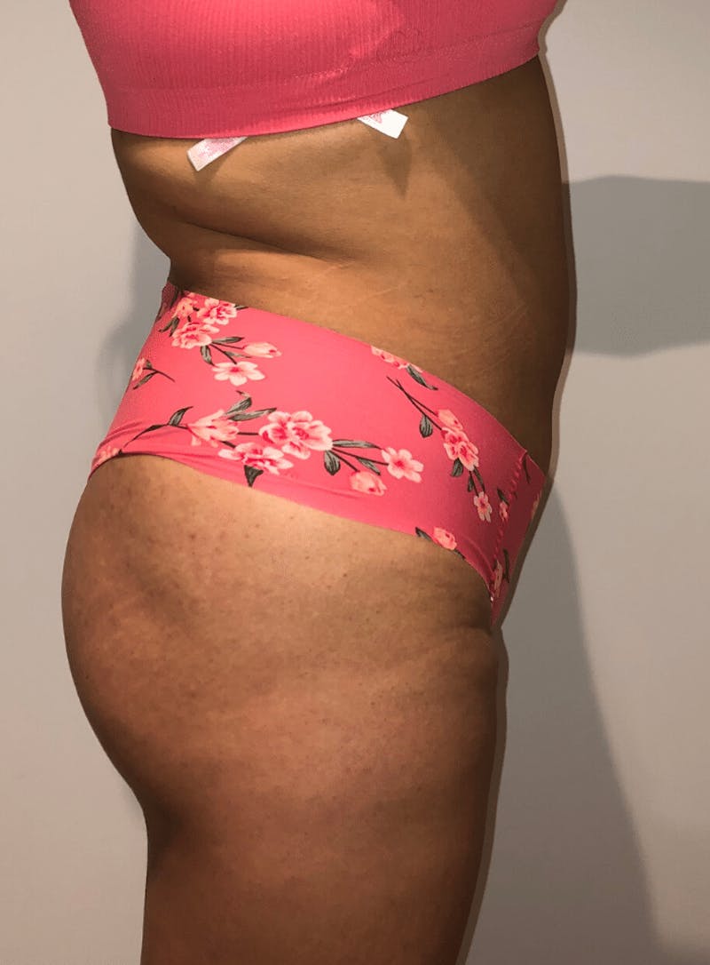 Brazilian Buttock Lift Before & After Gallery - Patient 200123 - Image 4