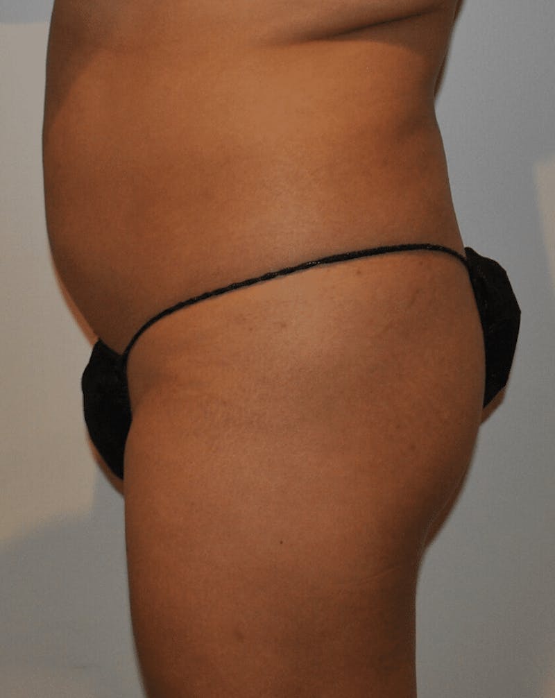 Brazilian Buttock Lift Before & After Gallery - Patient 200123 - Image 5