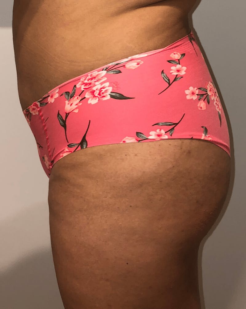 Brazilian Buttock Lift Before & After Gallery - Patient 200123 - Image 6