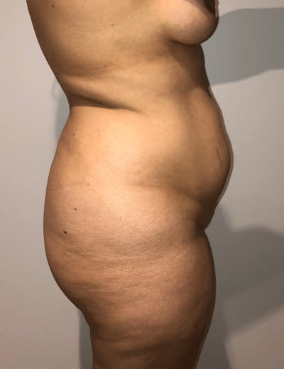 Brazilian Buttock Lift Before & After Gallery - Patient 332030 - Image 1