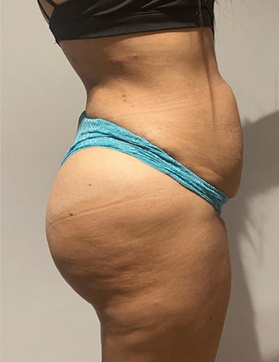 Brazilian Buttock Lift Before & After Gallery - Patient 332030 - Image 2