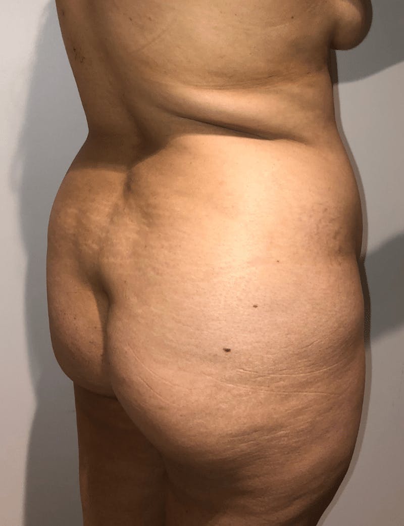 Brazilian Buttock Lift Before & After Gallery - Patient 332030 - Image 3