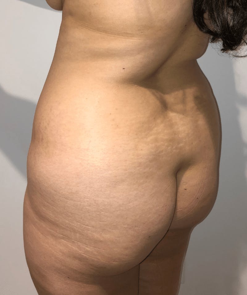 Brazilian Buttock Lift Before & After Gallery - Patient 332030 - Image 5