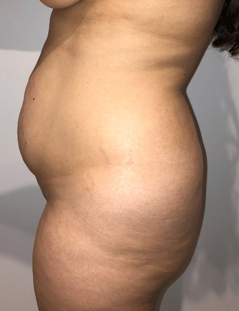 Brazilian Buttock Lift Before & After Gallery - Patient 332030 - Image 7