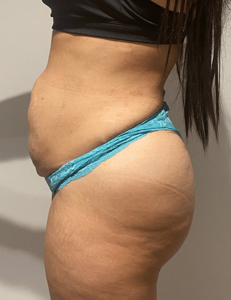 Brazilian Buttock Lift Before & After Gallery - Patient 332030 - Image 8