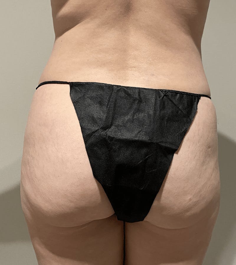Brazilian Buttock Lift Before & After Gallery - Patient 221402 - Image 1
