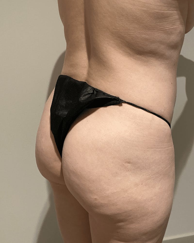 Brazilian Buttock Lift Before & After Gallery - Patient 221402 - Image 3