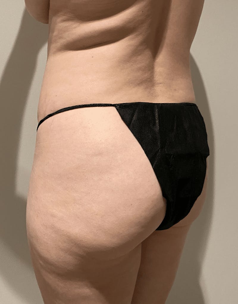 Brazilian Buttock Lift Before & After Gallery - Patient 221402 - Image 5
