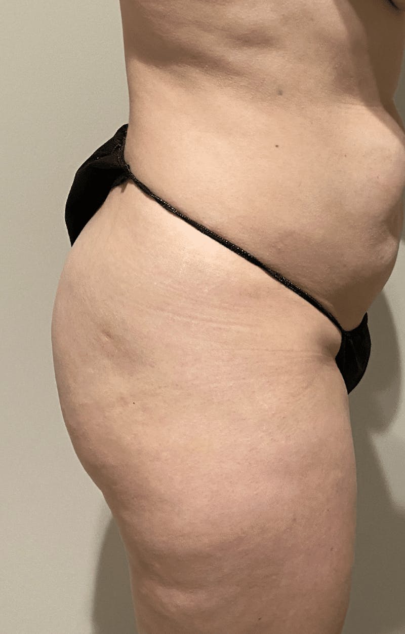 Brazilian Buttock Lift Before & After Gallery - Patient 221402 - Image 7