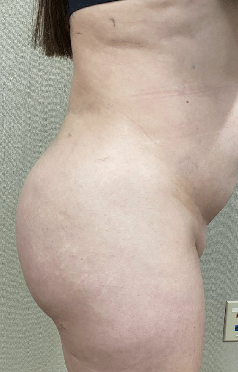 Brazilian Buttock Lift Before & After Gallery - Patient 221402 - Image 8