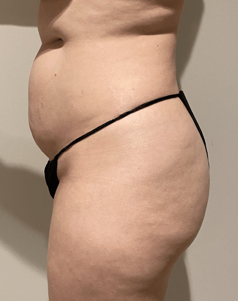 Brazilian Buttock Lift Before & After Gallery - Patient 221402 - Image 9