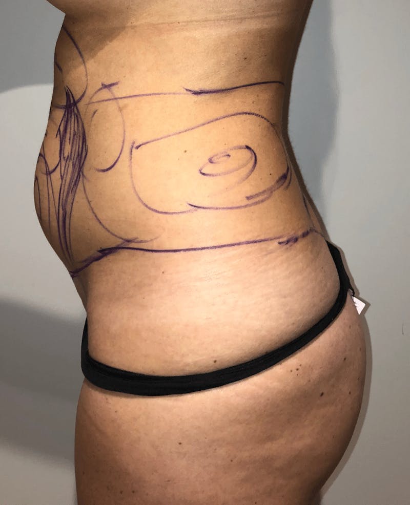 Brazilian Buttock Lift Before & After Gallery - Patient 389749 - Image 1