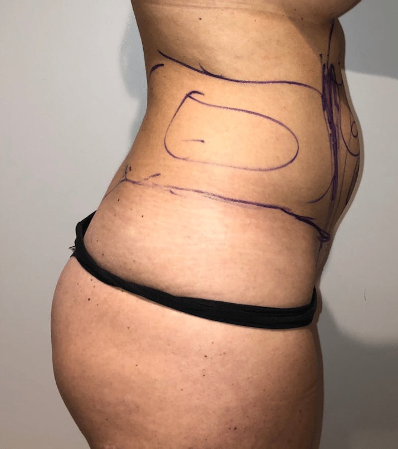 Brazilian Buttock Lift Before & After Gallery - Patient 389749 - Image 3