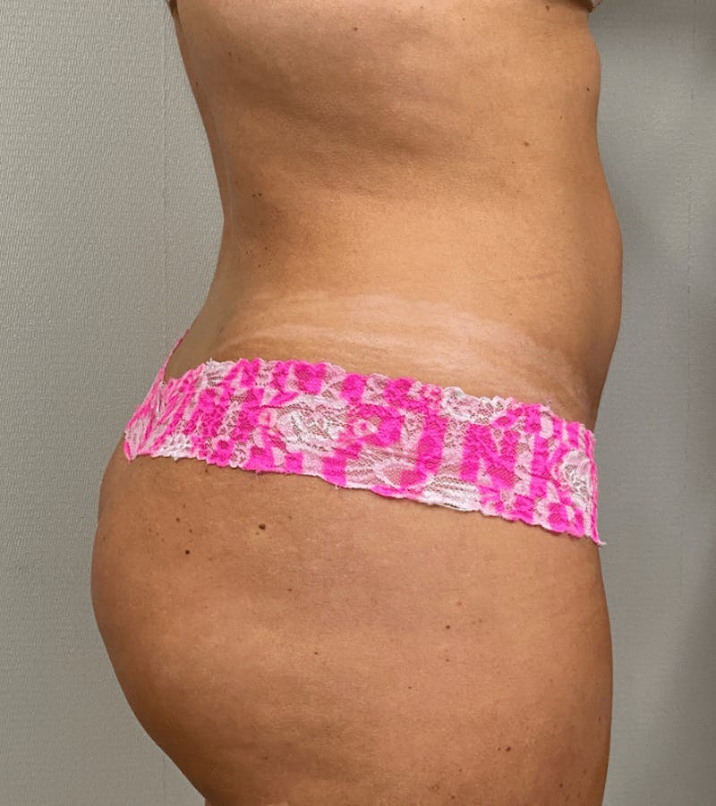 Brazilian Buttock Lift Before & After Gallery - Patient 389749 - Image 4