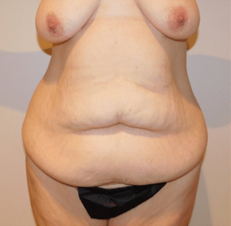Post-Massive Weight Loss Surgery Before & After Gallery - Patient 356664 - Image 1