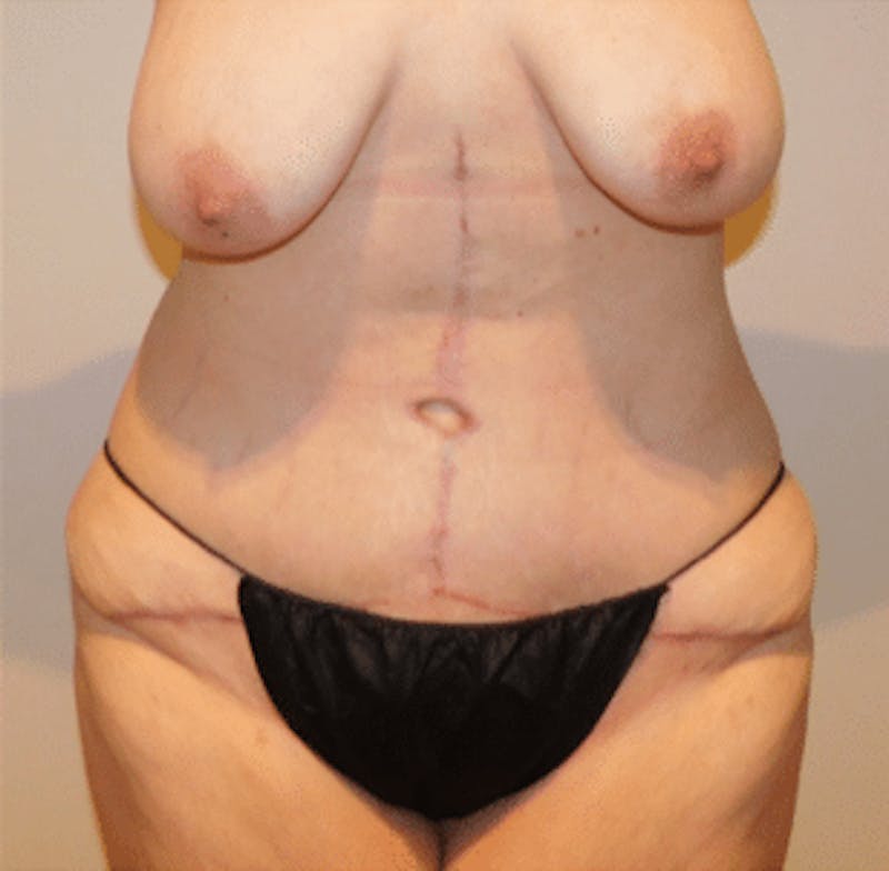 Post-Massive Weight Loss Surgery Before & After Gallery - Patient 356664 - Image 2