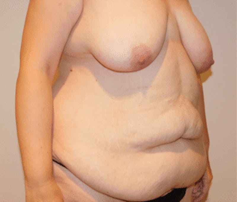 Post-Massive Weight Loss Surgery Before & After Gallery - Patient 356664 - Image 3