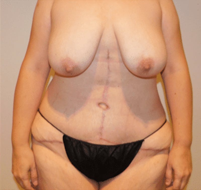 Post-Massive Weight Loss Surgery Before & After Gallery - Patient 356664 - Image 6