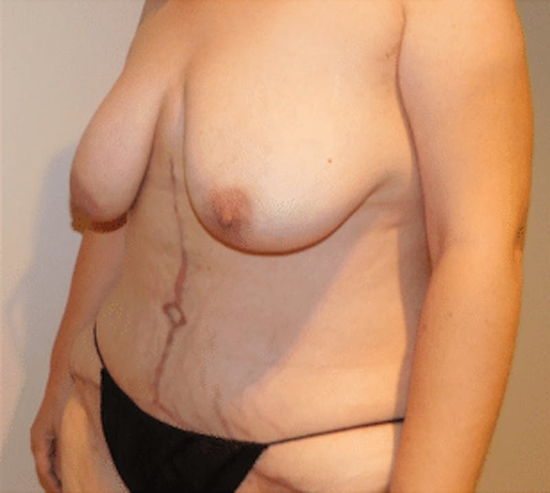 Post-Massive Weight Loss Surgery Before & After Gallery - Patient 356664 - Image 8