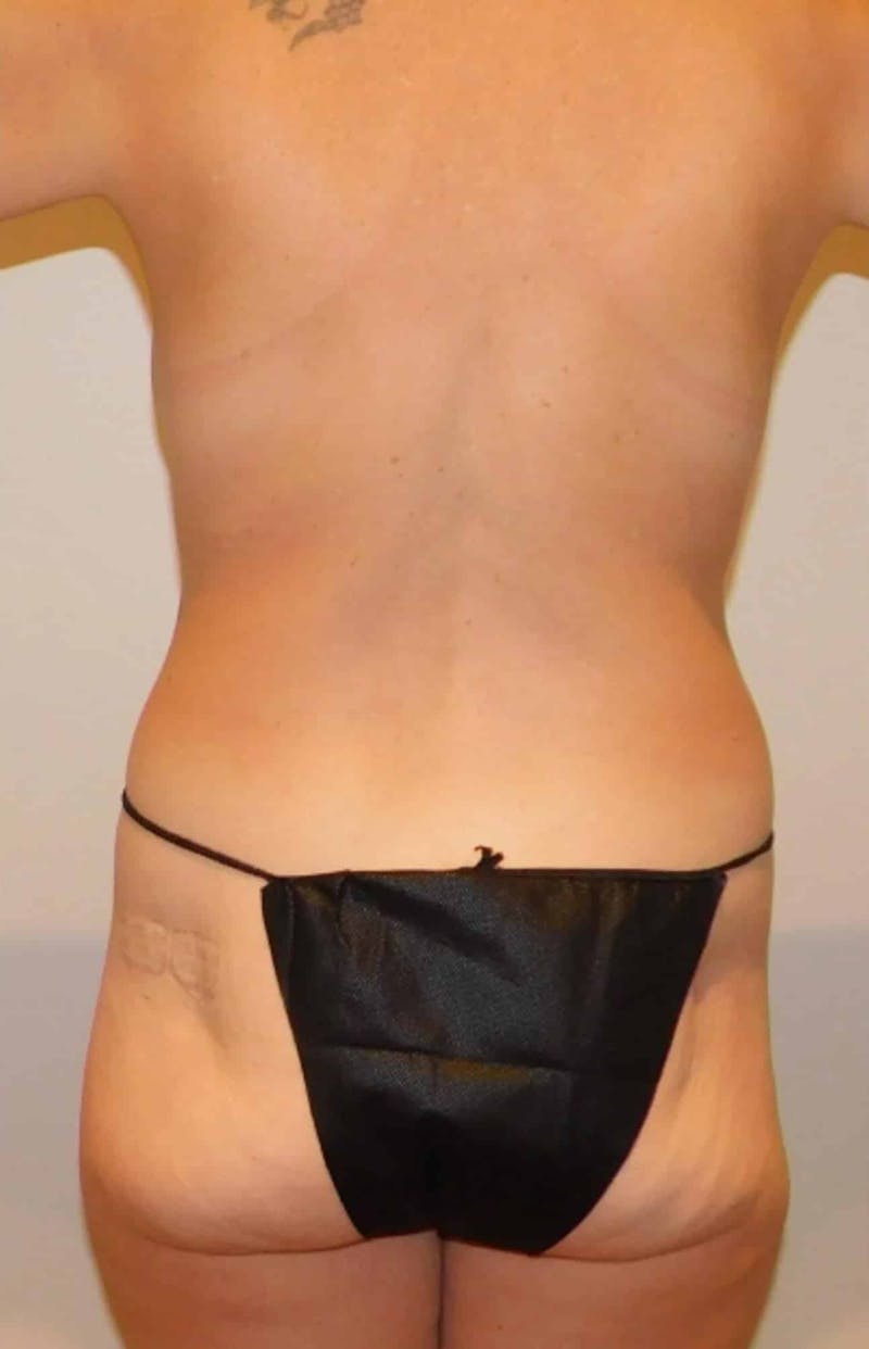 Mommy Makeover Before & After Gallery - Patient 254546 - Image 9