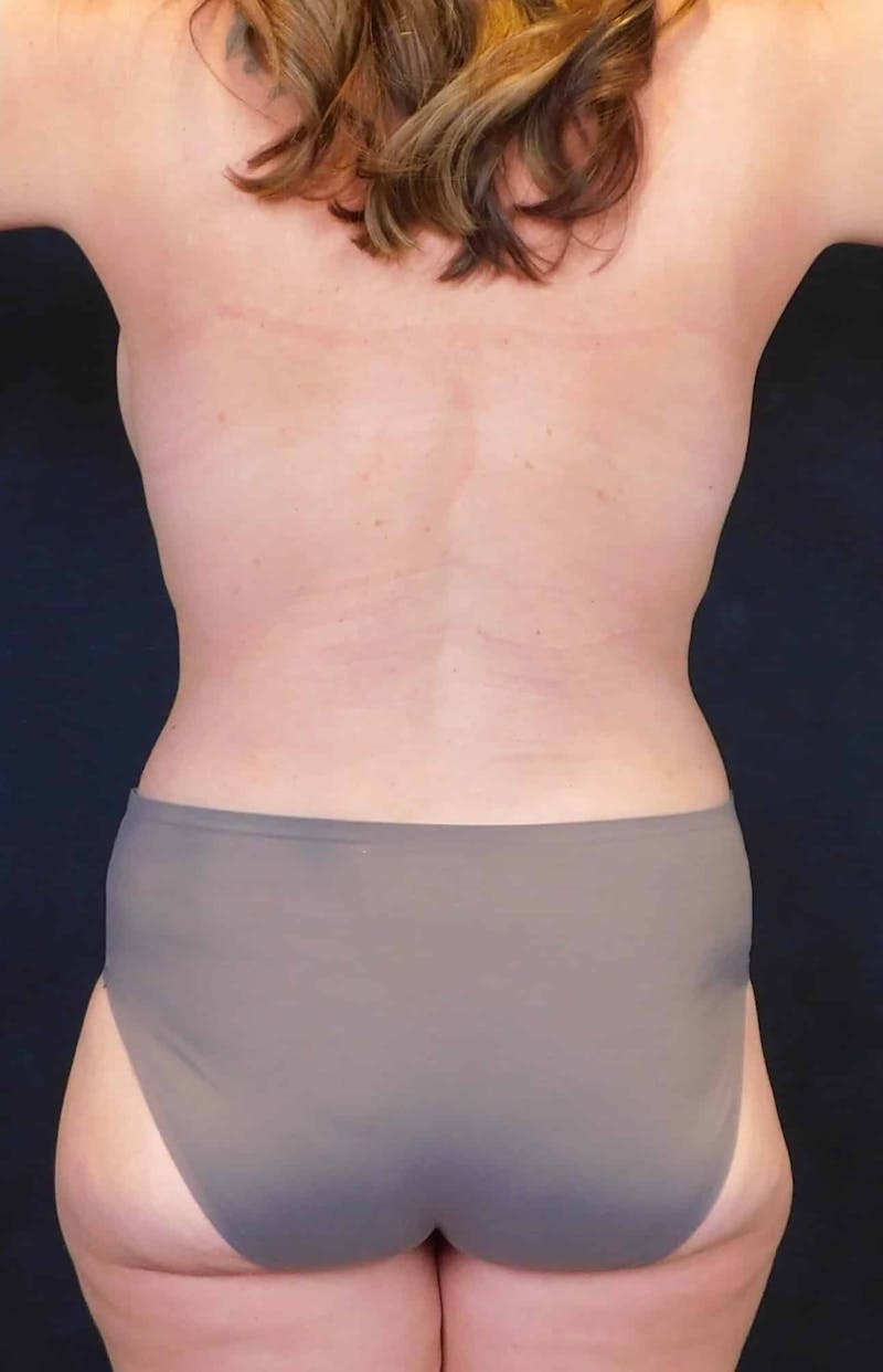 Mommy Makeover Before & After Gallery - Patient 254546 - Image 10