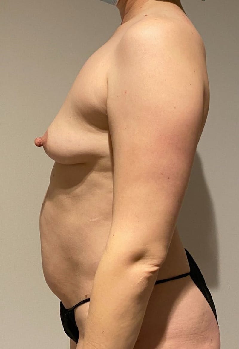 Mommy Makeover Before & After Gallery - Patient 713152 - Image 7