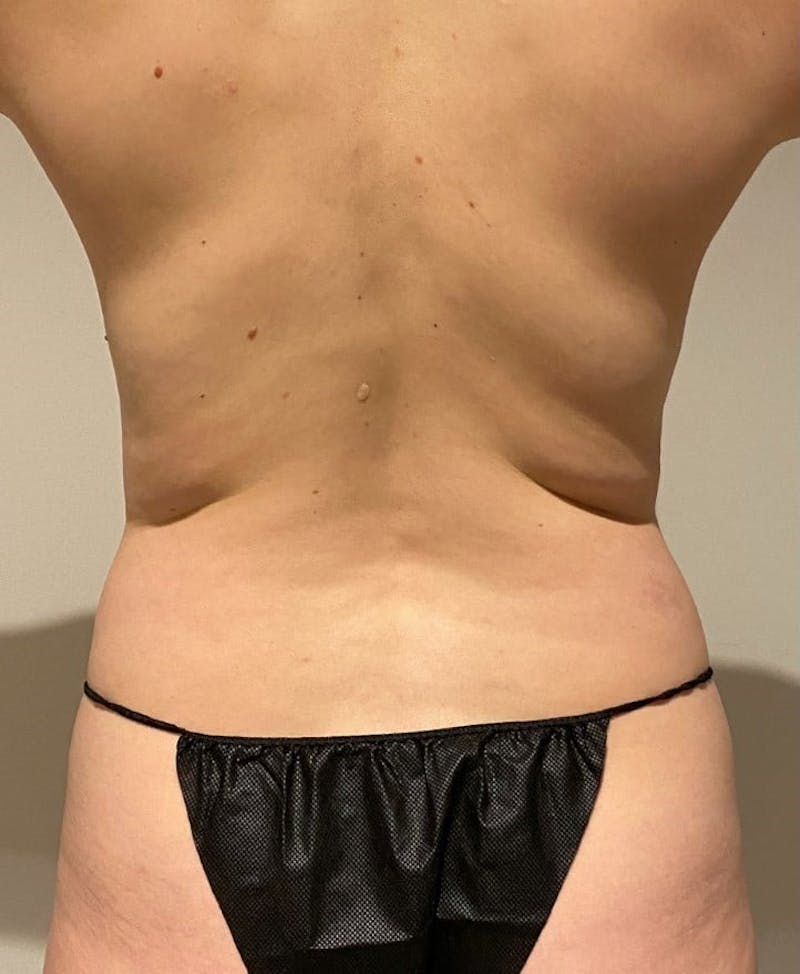 Mommy Makeover Before & After Gallery - Patient 713152 - Image 9