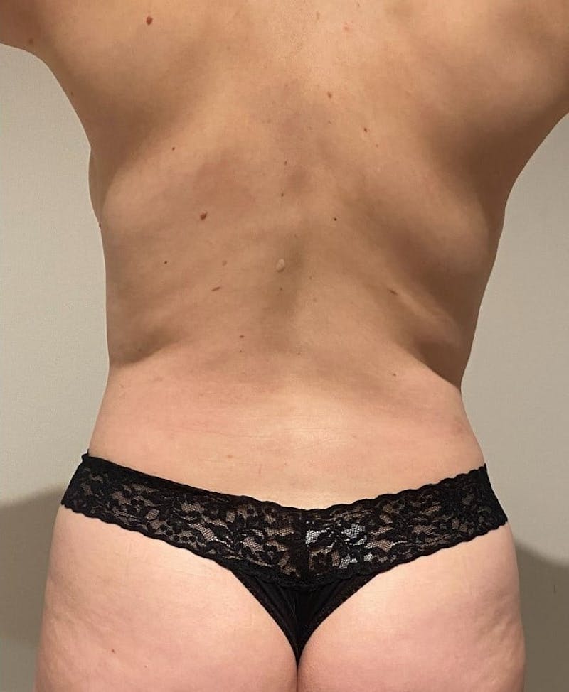 Mommy Makeover Before & After Gallery - Patient 713152 - Image 10